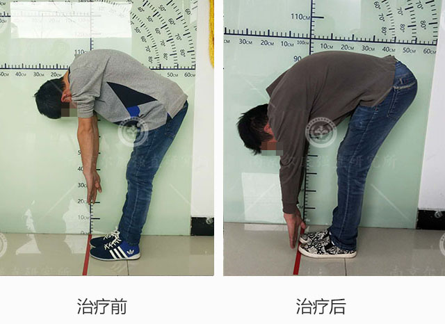 治疗前:来院时主诉腰痛伴晨僵,全脊柱多方向活动受限;查体:枕墙距16cm